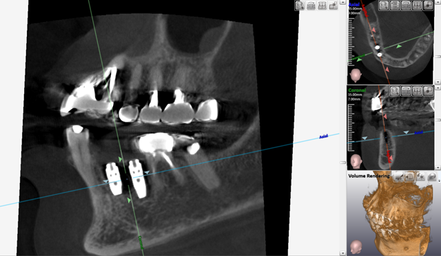 歯科用 CT